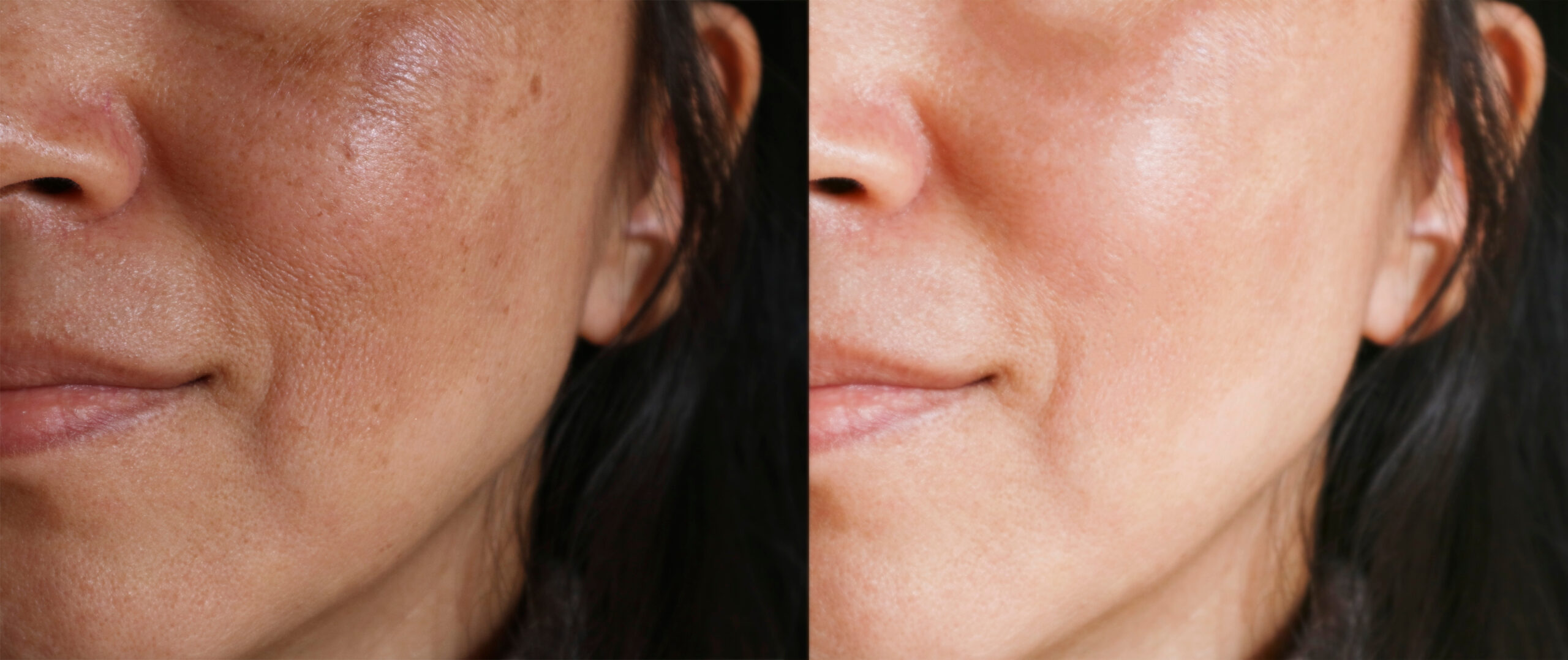 Melasma