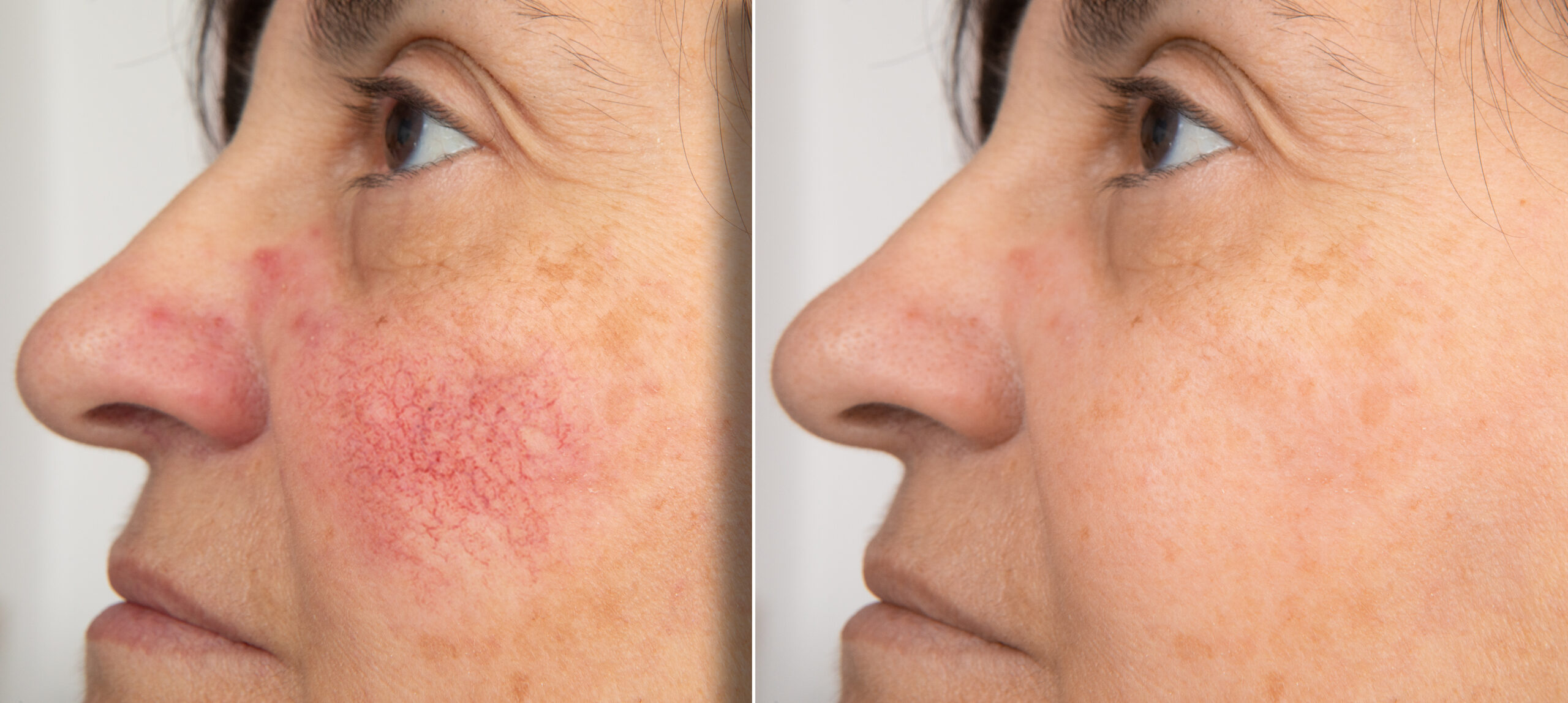 Rosacea