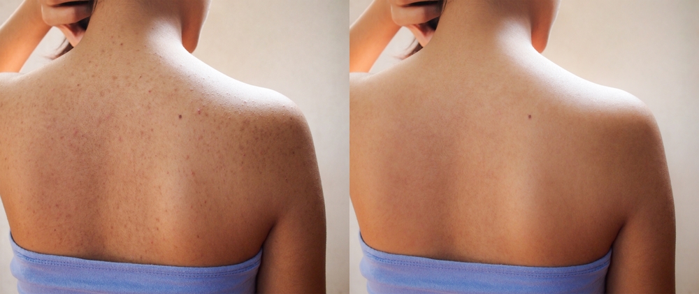 Back Acne