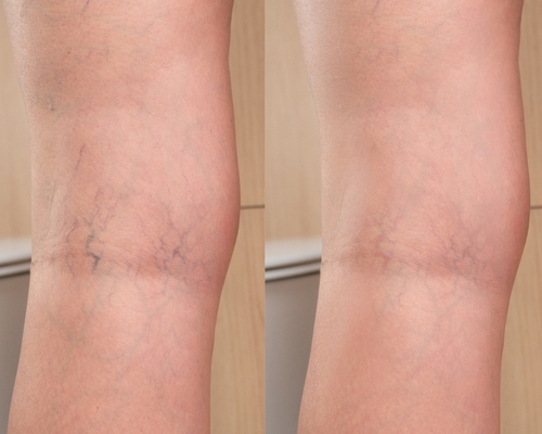 Leg Veins