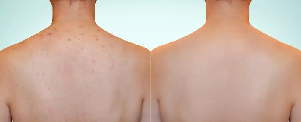 Back Acne