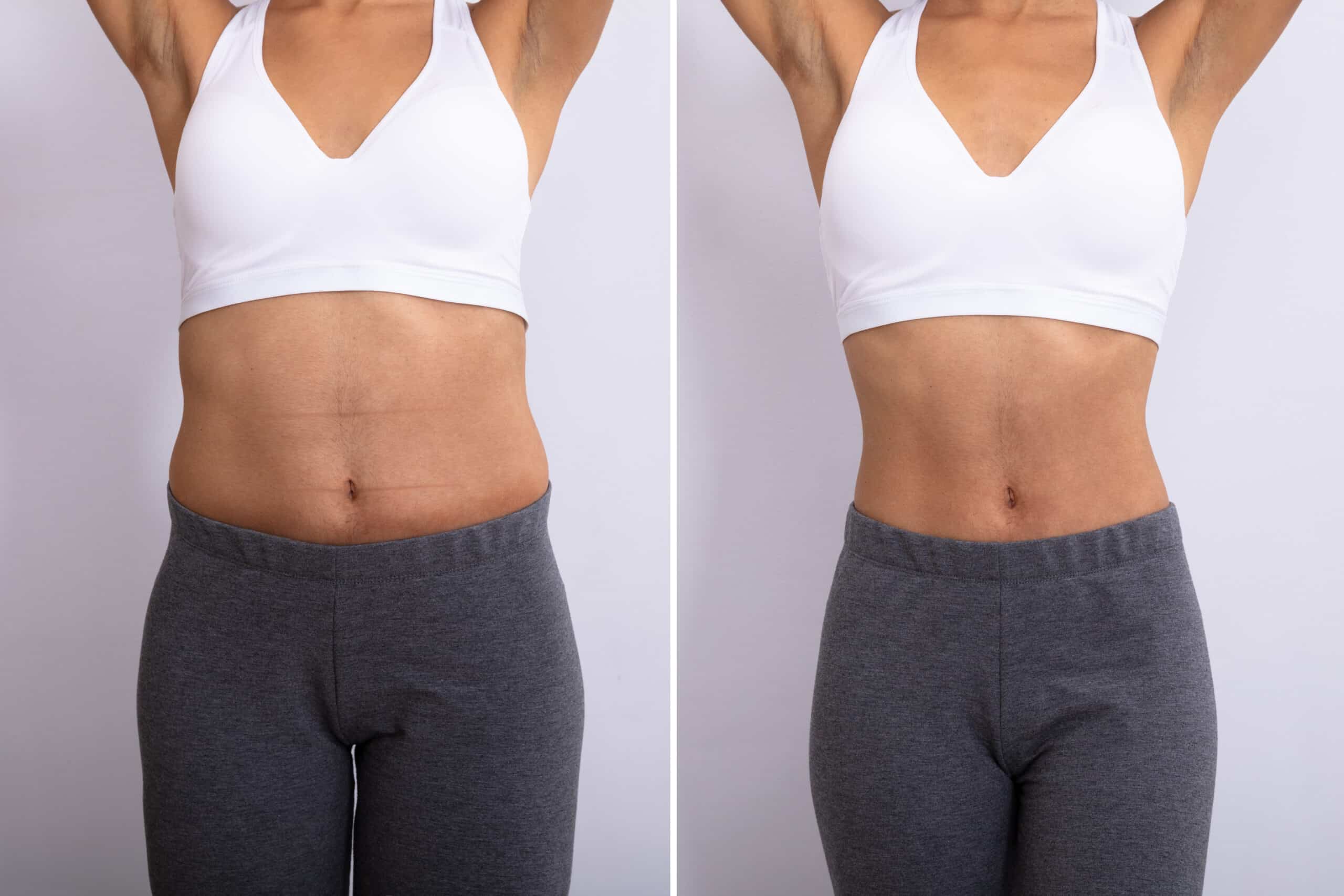 Body Shaping & Contouring In Oviedo, FL 2 Abs & Flanks