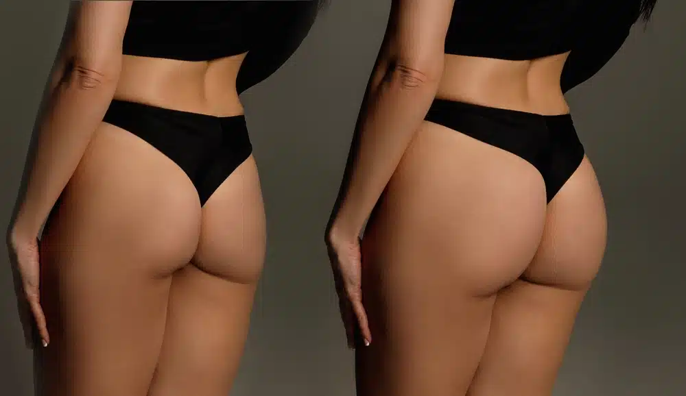 Body Shaping & Contouring In Oviedo, FL 4 Glutes & Thighs
