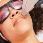 A patient wearing protective eyewear receiving a laser hair removal treatment on the upper lip area from a professional technician at Golden Sky Medicine.
