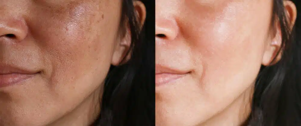 Melasma