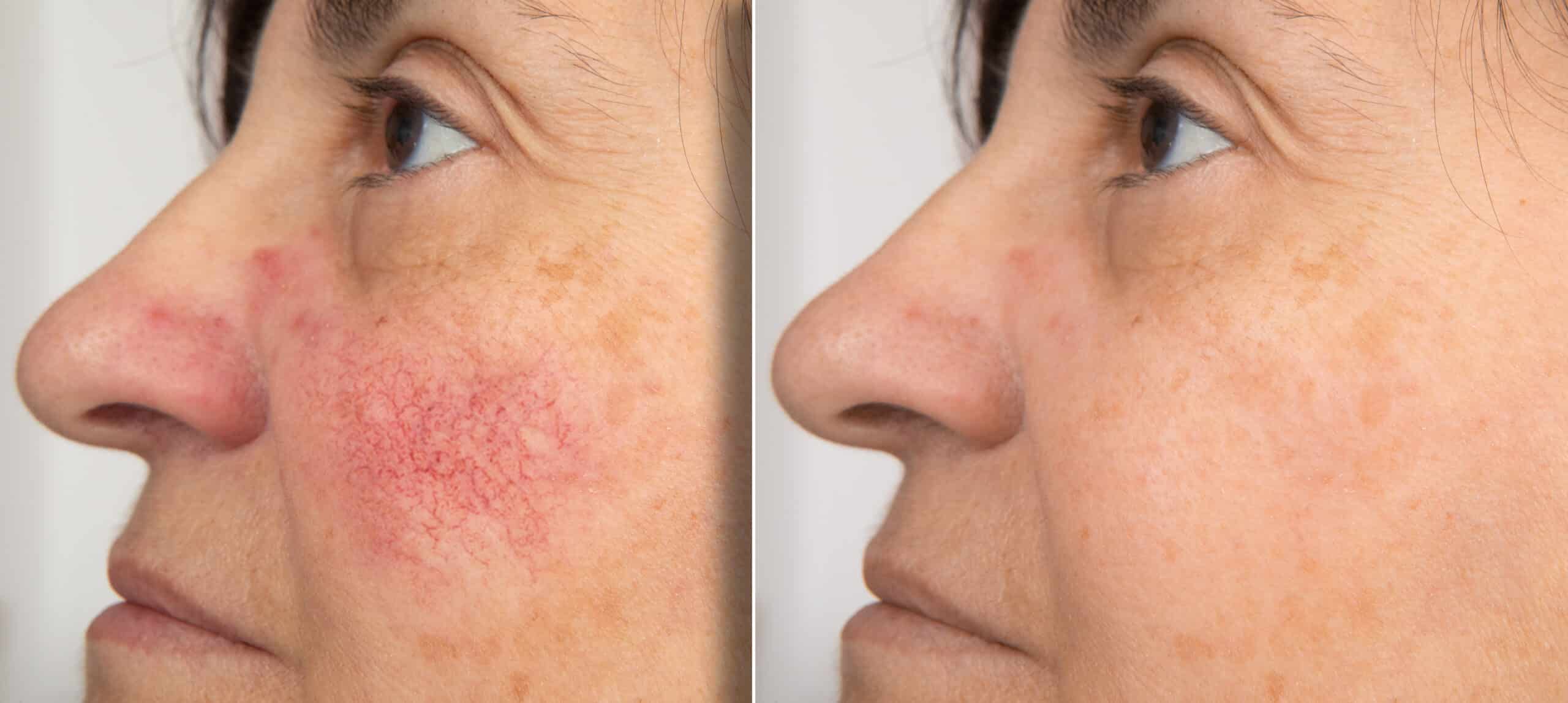 Rosacea