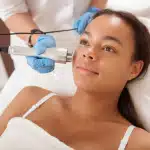 A patient undergoing a non-invasive skin tightening treatment on her cheek with a specialized radiofrequency device at Golden Sky Medicine.